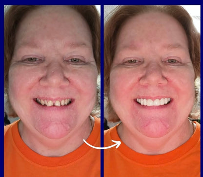 Snap On Smile (SI) 9