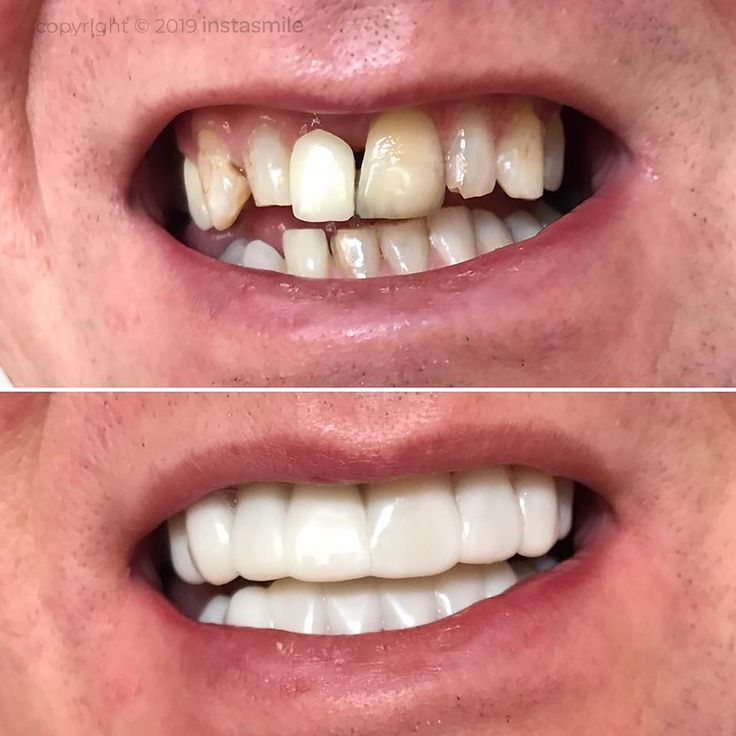 Snap On Smile (SI) 3